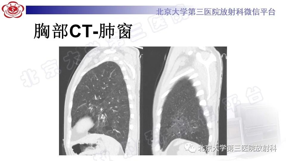 影像PPT - 【PPT】病毒性肺炎-8