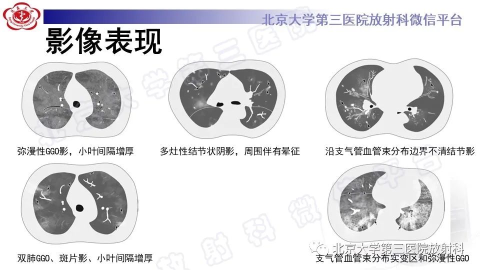 影像PPT - 【PPT】病毒性肺炎-14