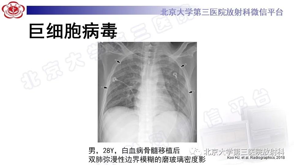 影像PPT - 【PPT】病毒性肺炎-17