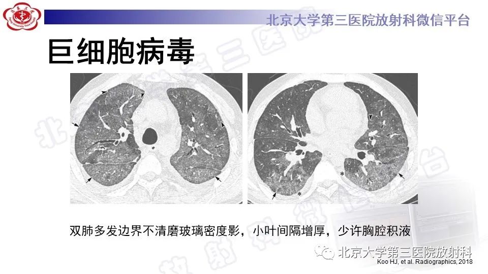 影像PPT - 【PPT】病毒性肺炎-18