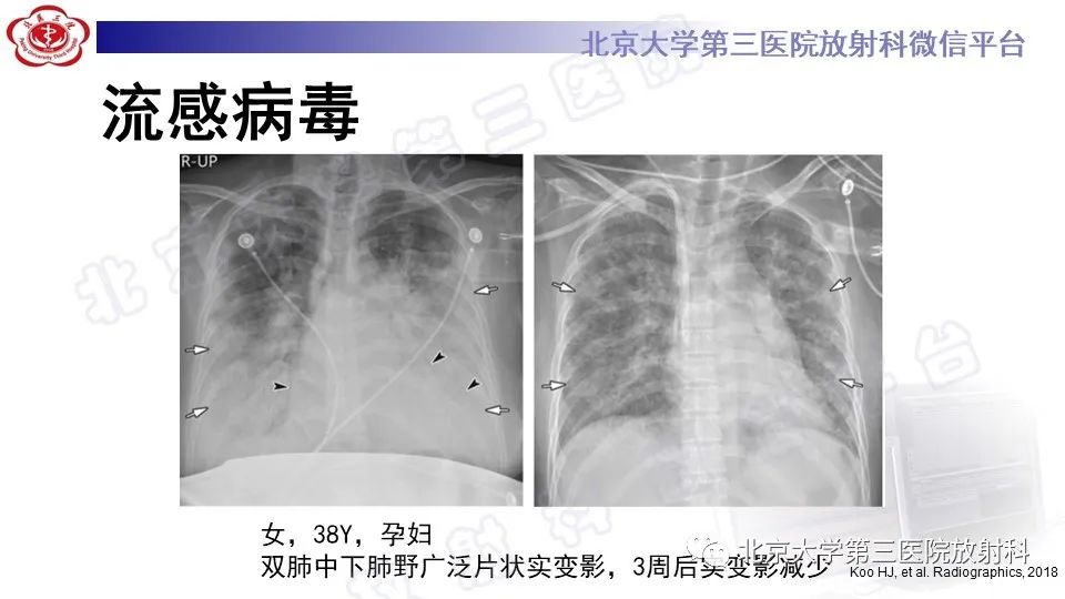 影像PPT - 【PPT】病毒性肺炎-21