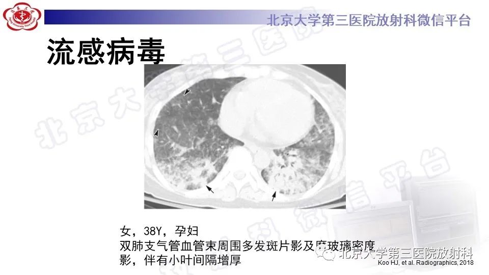 影像PPT - 【PPT】病毒性肺炎-22