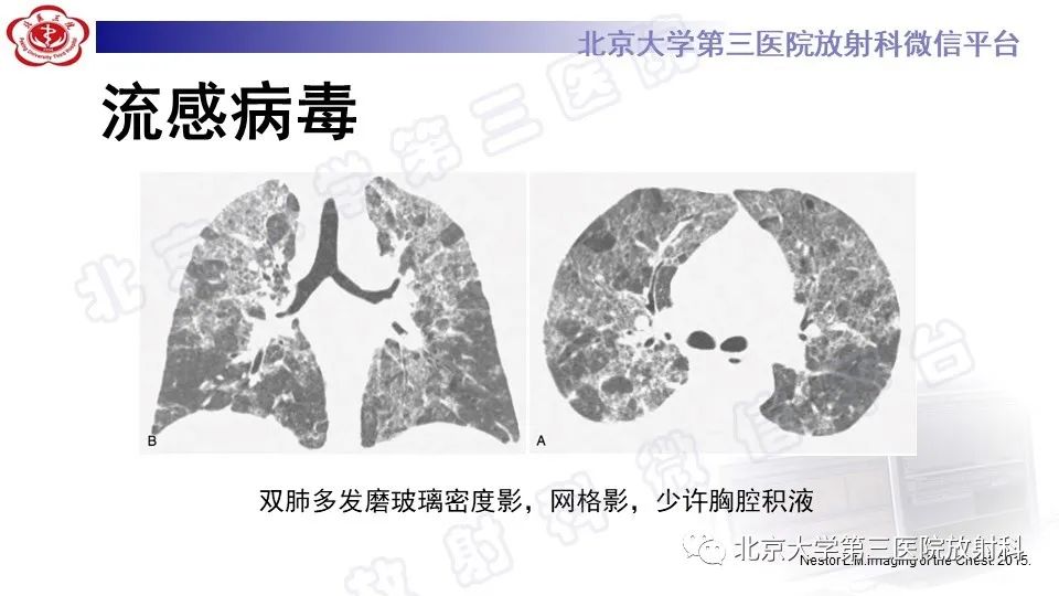 影像PPT - 【PPT】病毒性肺炎-23