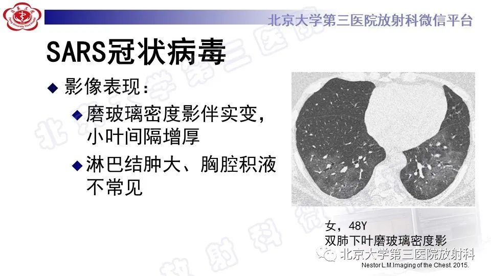 影像PPT - 【PPT】病毒性肺炎-25