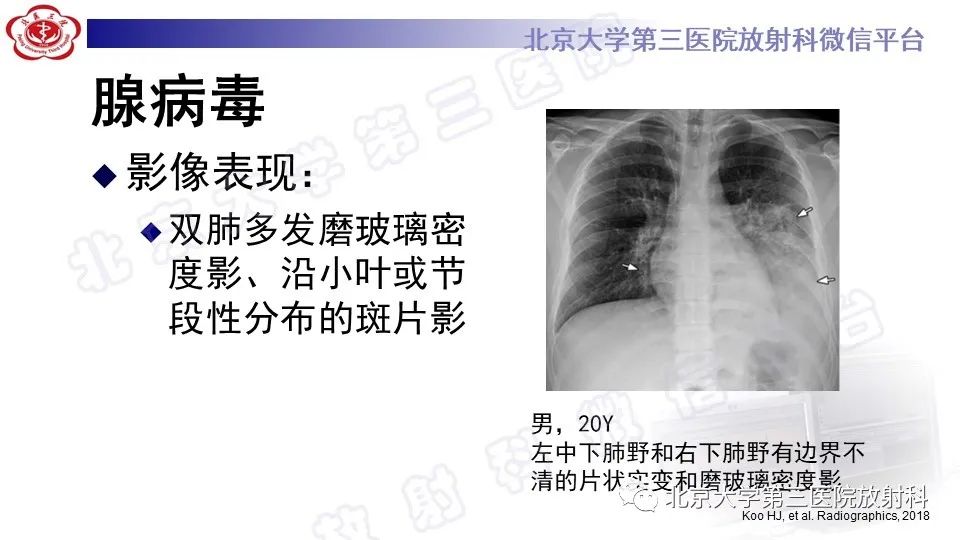影像PPT - 【PPT】病毒性肺炎-28