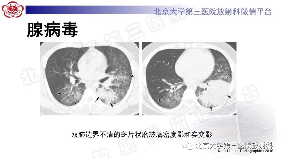 影像PPT - 【PPT】病毒性肺炎-29