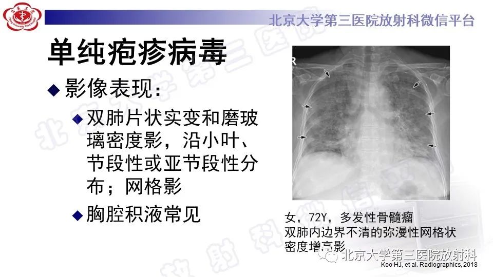 影像PPT - 【PPT】病毒性肺炎-32