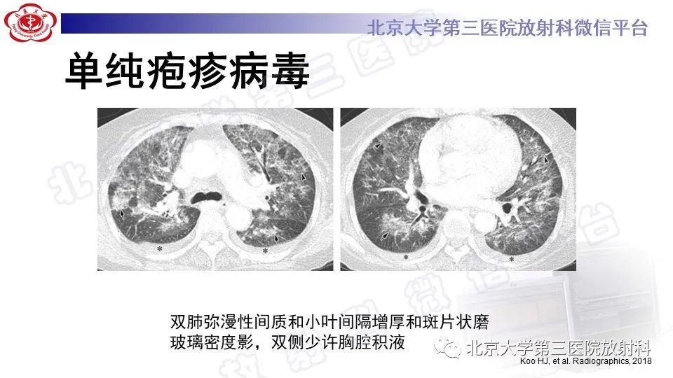 影像PPT - 【PPT】病毒性肺炎-33