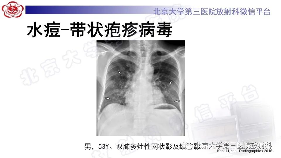 影像PPT - 【PPT】病毒性肺炎-36