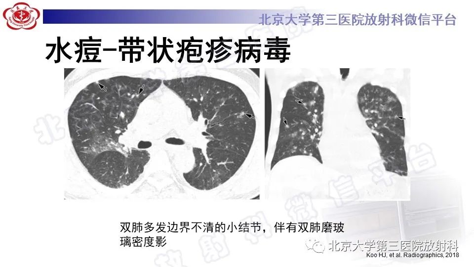 影像PPT - 【PPT】病毒性肺炎-37