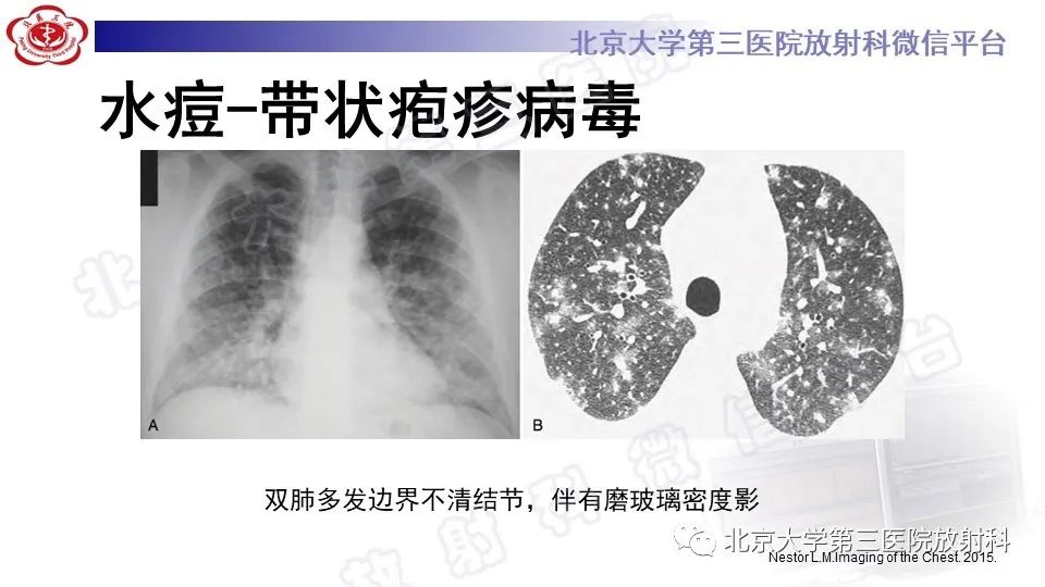 影像PPT - 【PPT】病毒性肺炎-38