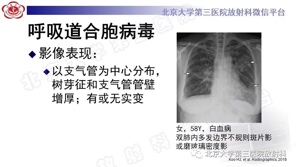 影像PPT - 【PPT】病毒性肺炎-40