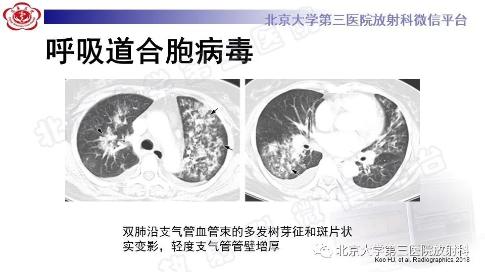 影像PPT - 【PPT】病毒性肺炎-41