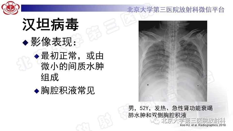 影像PPT - 【PPT】病毒性肺炎-43