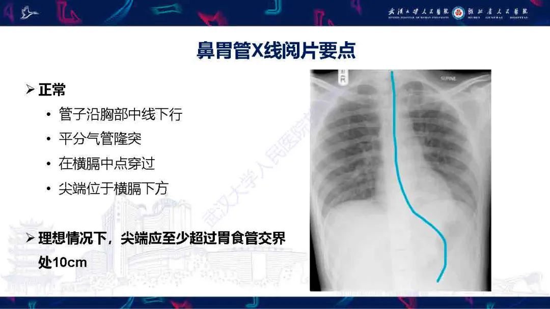 影像PPT - 【PPT】胃肠营养管影像评估-6