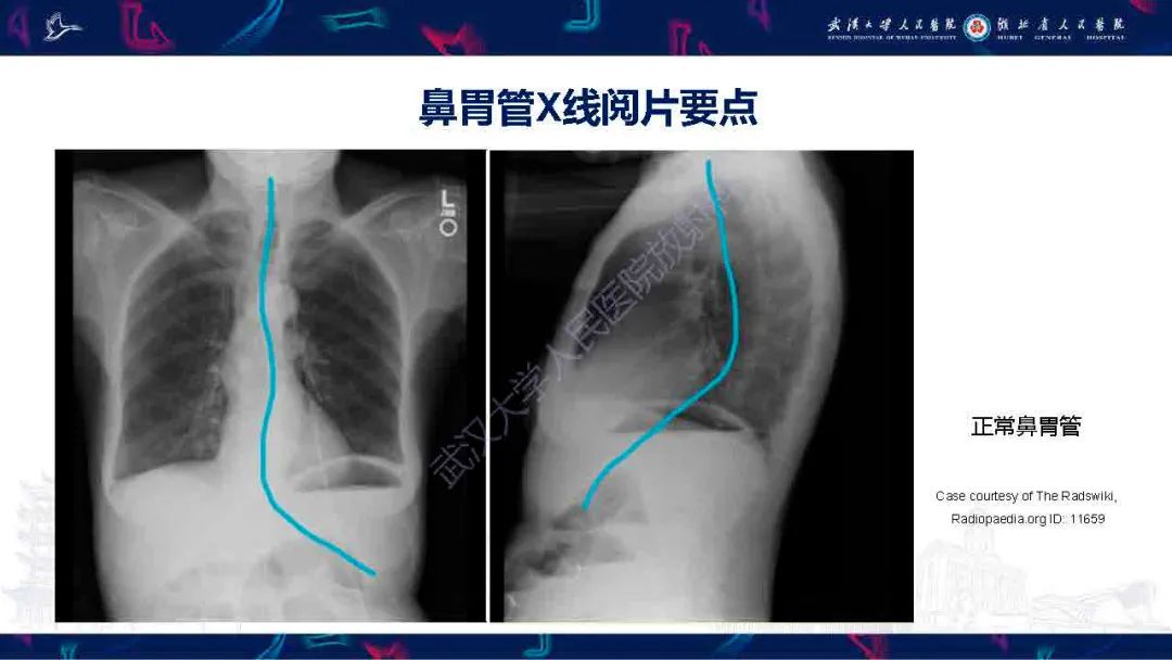 影像PPT - 【PPT】胃肠营养管影像评估-7