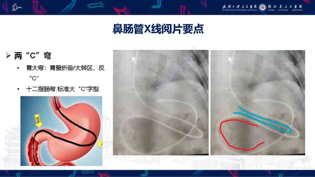 影像PPT - 【PPT】胃肠营养管影像评估-9