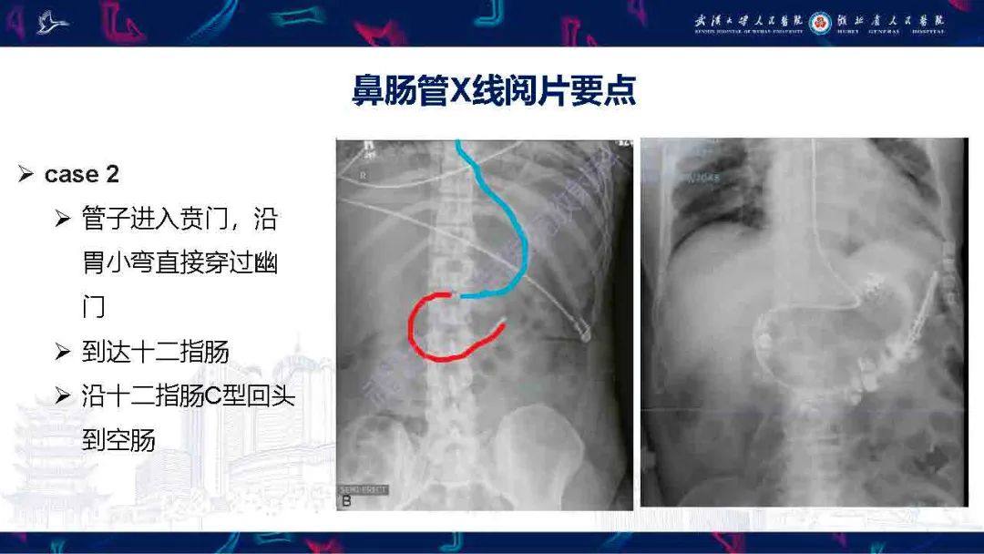 影像PPT - 【PPT】胃肠营养管影像评估-10