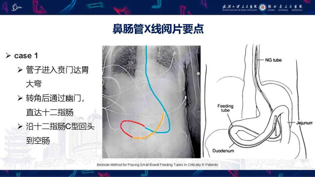 影像PPT - 【PPT】胃肠营养管影像评估-8