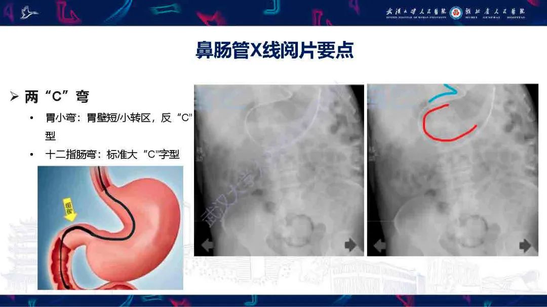 影像PPT - 【PPT】胃肠营养管影像评估-11