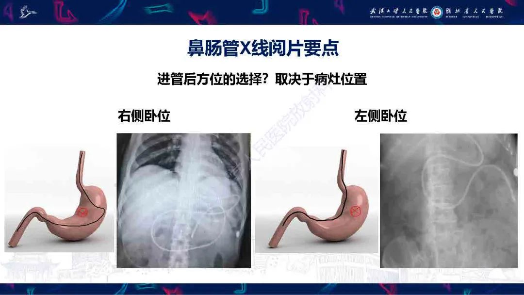 影像PPT - 【PPT】胃肠营养管影像评估-12