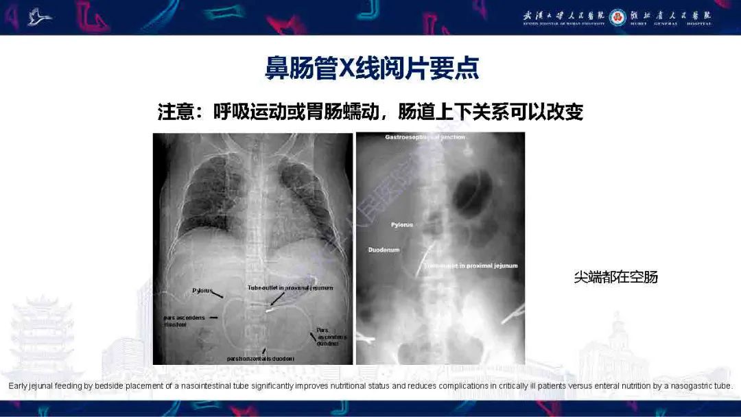 影像PPT - 【PPT】胃肠营养管影像评估-13