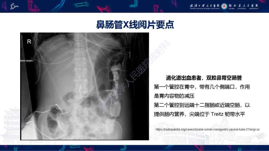 影像PPT - 【PPT】胃肠营养管影像评估-15