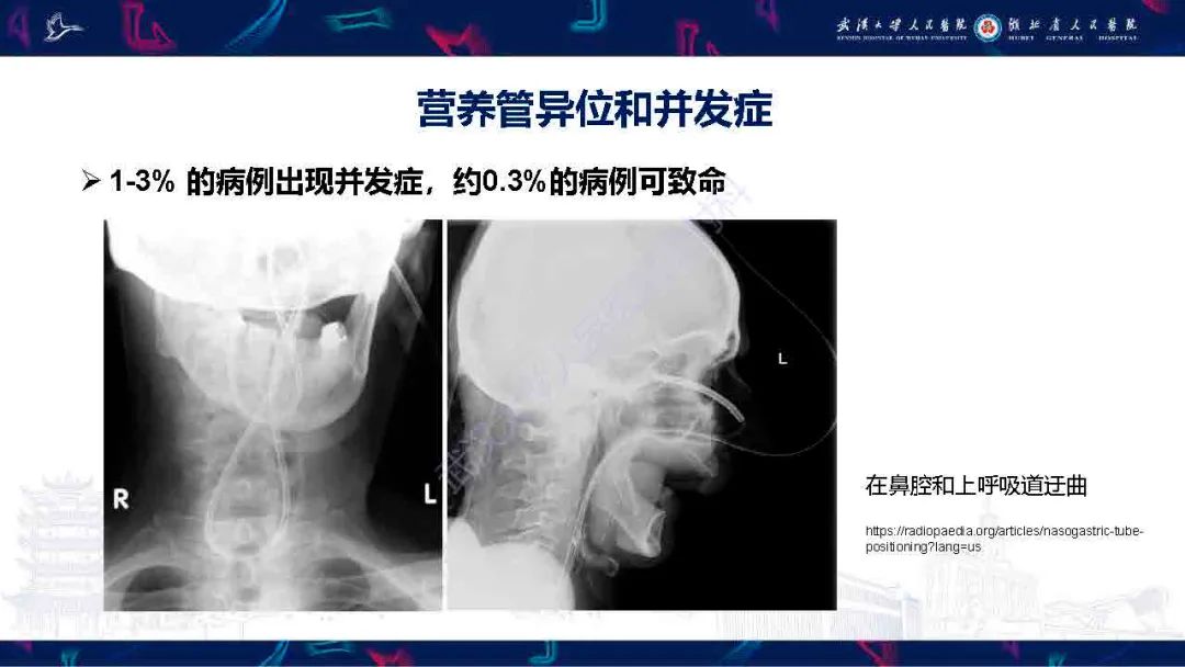 影像PPT - 【PPT】胃肠营养管影像评估-16