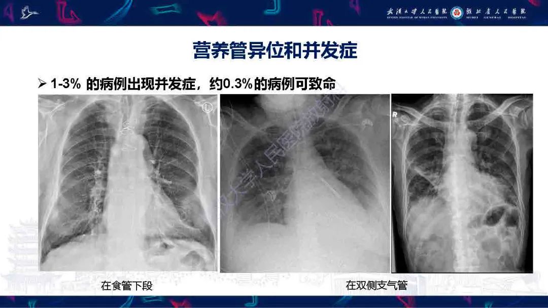 影像PPT - 【PPT】胃肠营养管影像评估-17