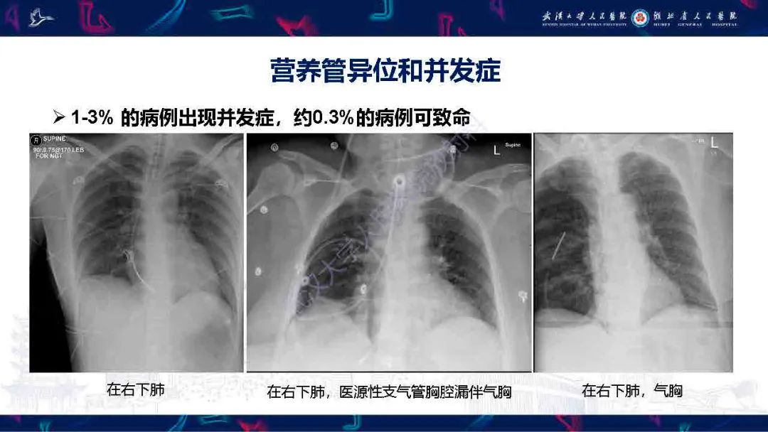 影像PPT - 【PPT】胃肠营养管影像评估-18