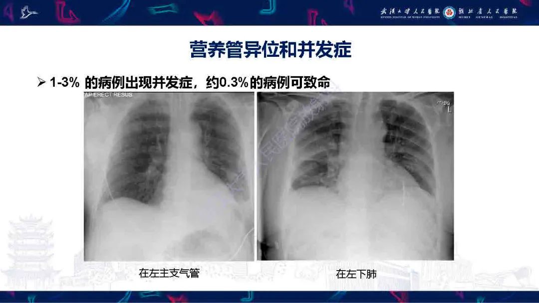 影像PPT - 【PPT】胃肠营养管影像评估-19
