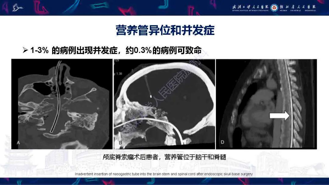 影像PPT - 【PPT】胃肠营养管影像评估-20