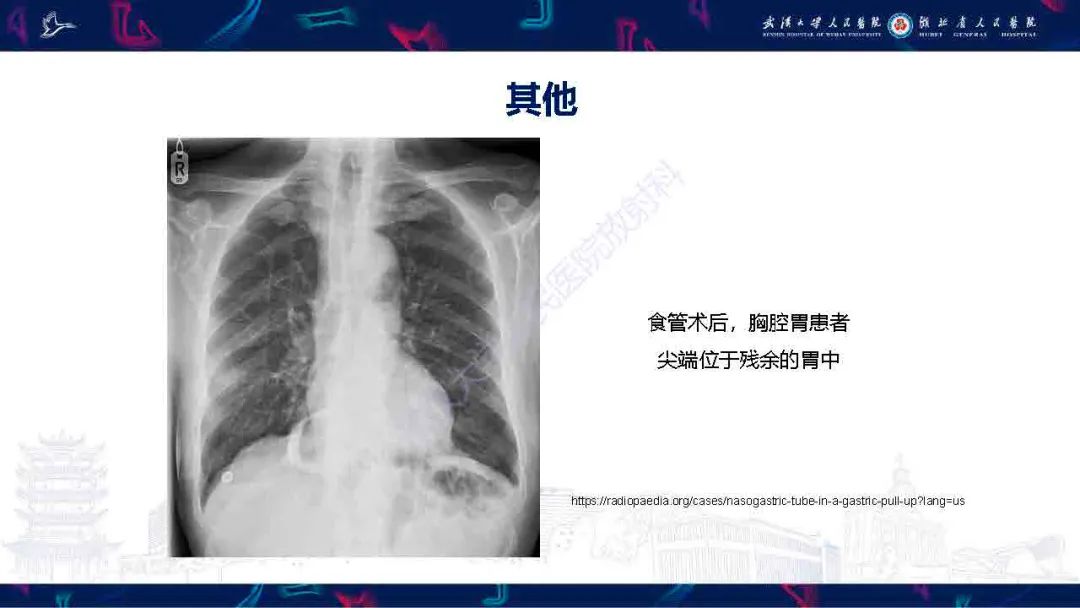 影像PPT - 【PPT】胃肠营养管影像评估-22