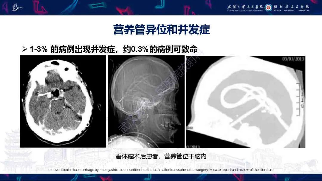 影像PPT - 【PPT】胃肠营养管影像评估-21