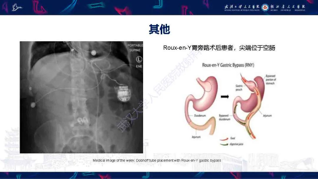影像PPT - 【PPT】胃肠营养管影像评估-23