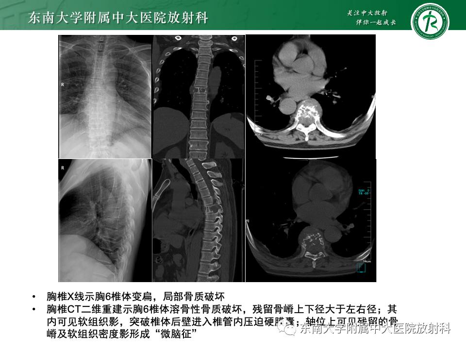 影像PPT - 【PPT】骨孤立性浆细胞瘤-4