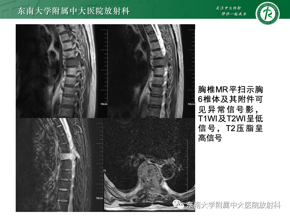 影像PPT - 【PPT】骨孤立性浆细胞瘤-5