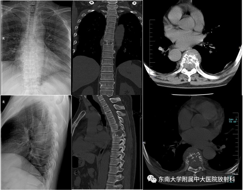 影像PPT - 【PPT】骨孤立性浆细胞瘤-1