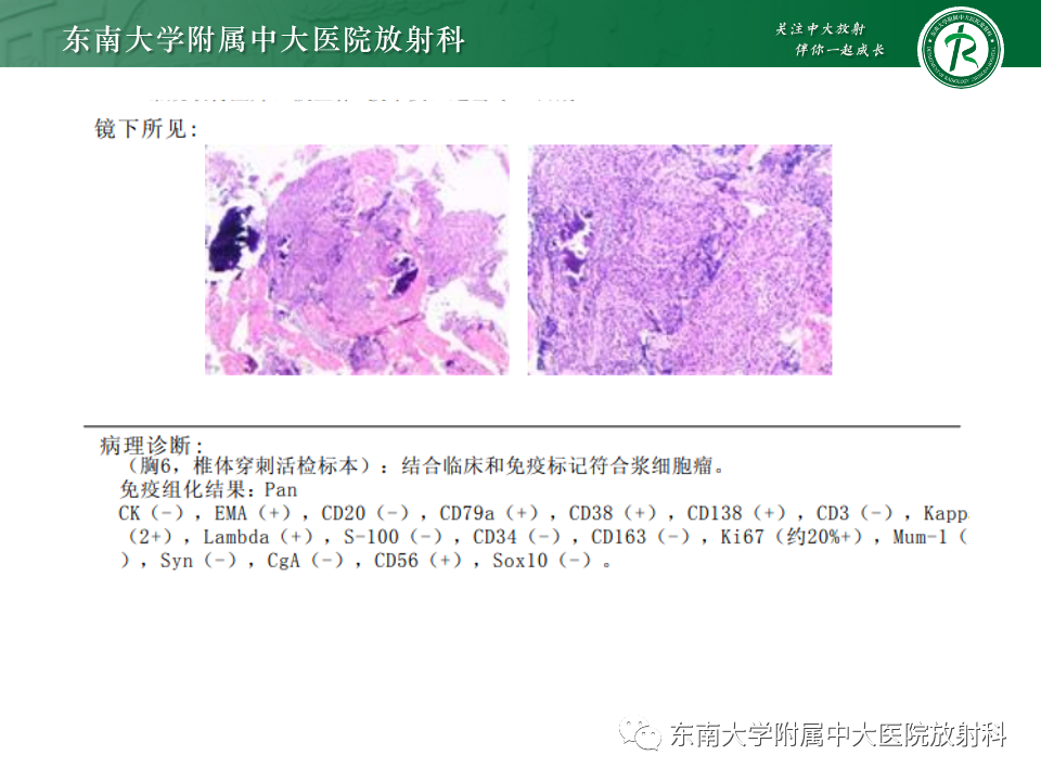 影像PPT - 【PPT】骨孤立性浆细胞瘤-6