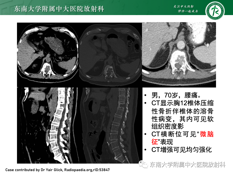 影像PPT - 【PPT】骨孤立性浆细胞瘤-14