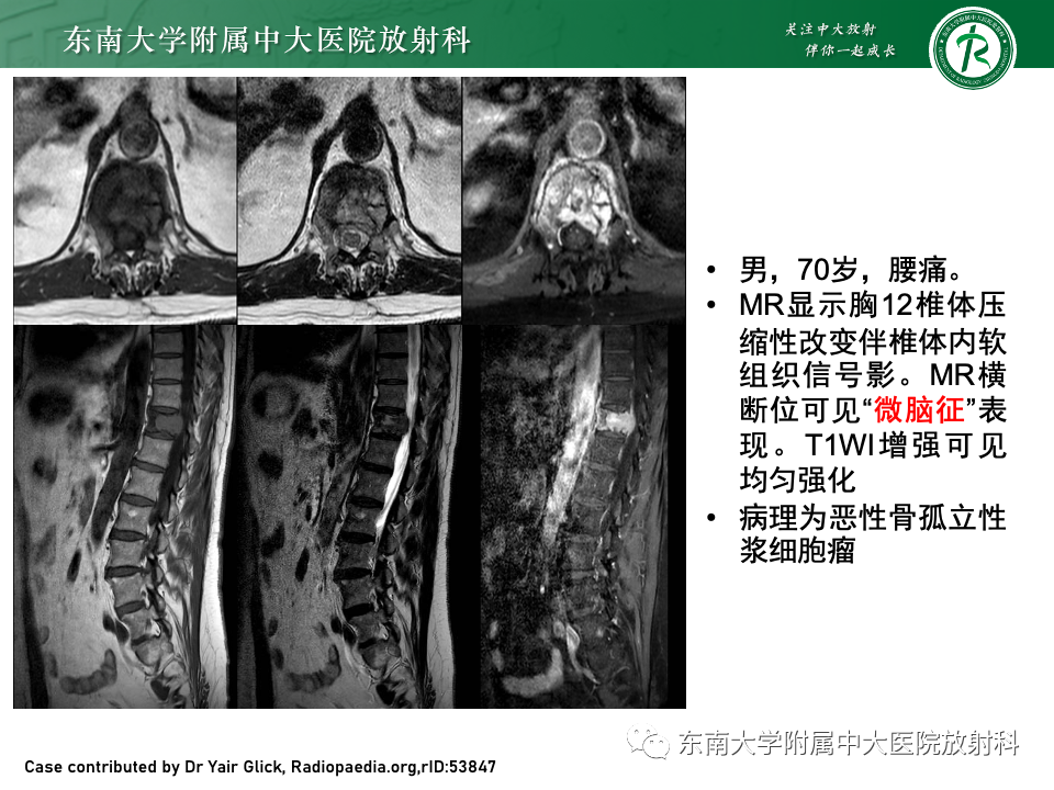 影像PPT - 【PPT】骨孤立性浆细胞瘤-15