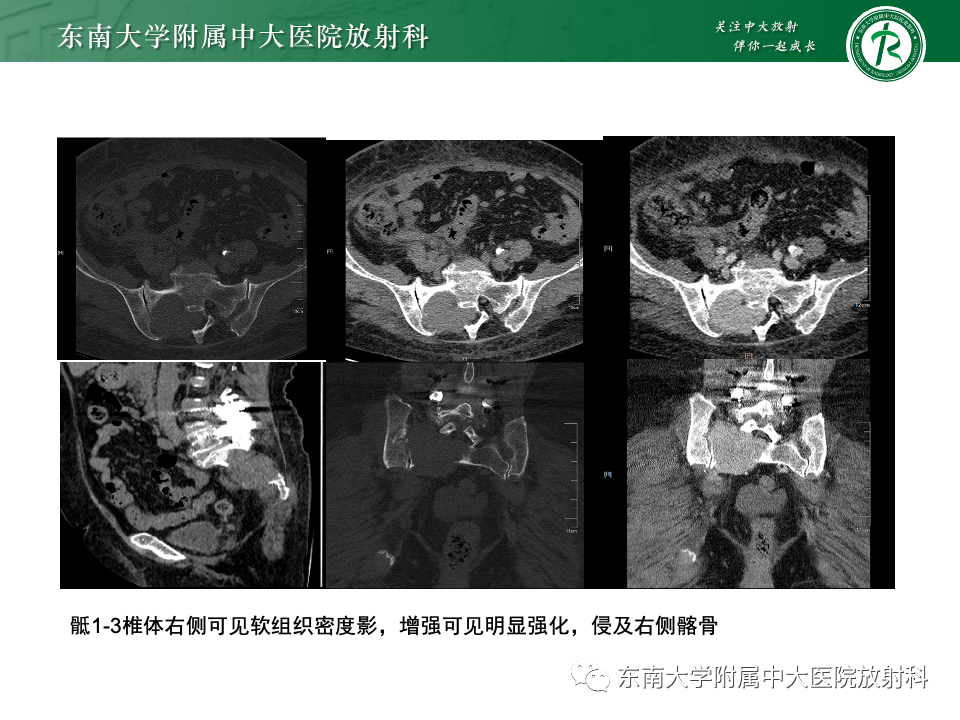 影像PPT - 【PPT】骨孤立性浆细胞瘤-17