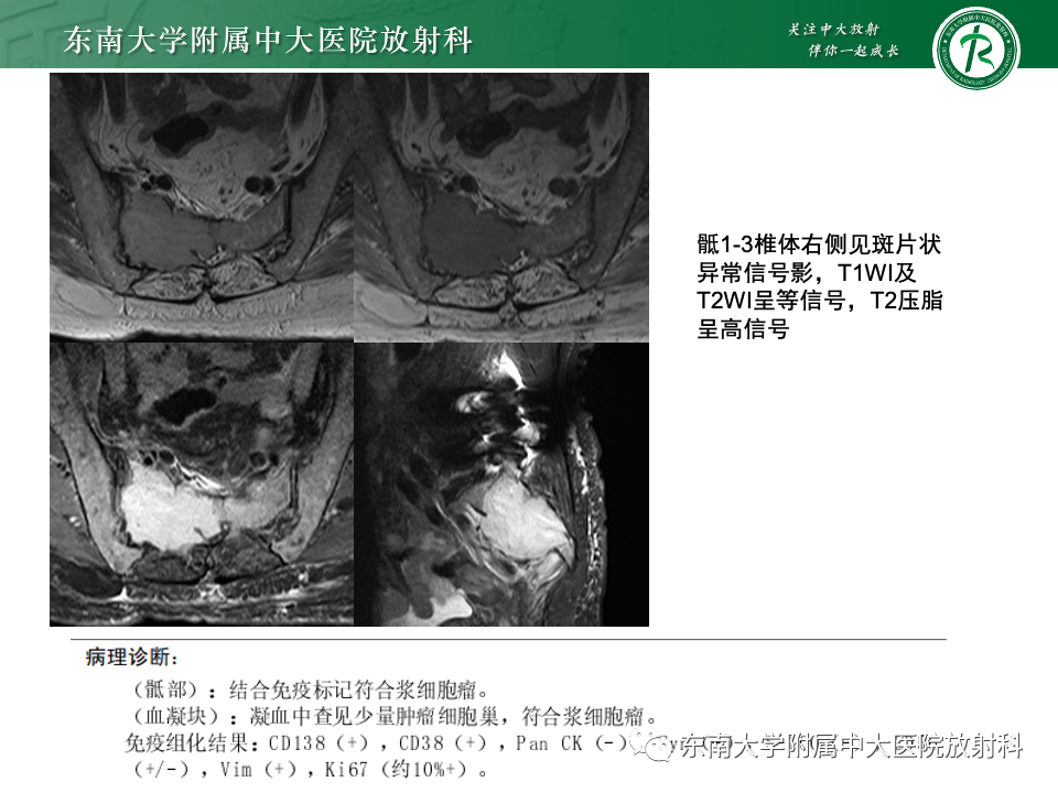 影像PPT - 【PPT】骨孤立性浆细胞瘤-18