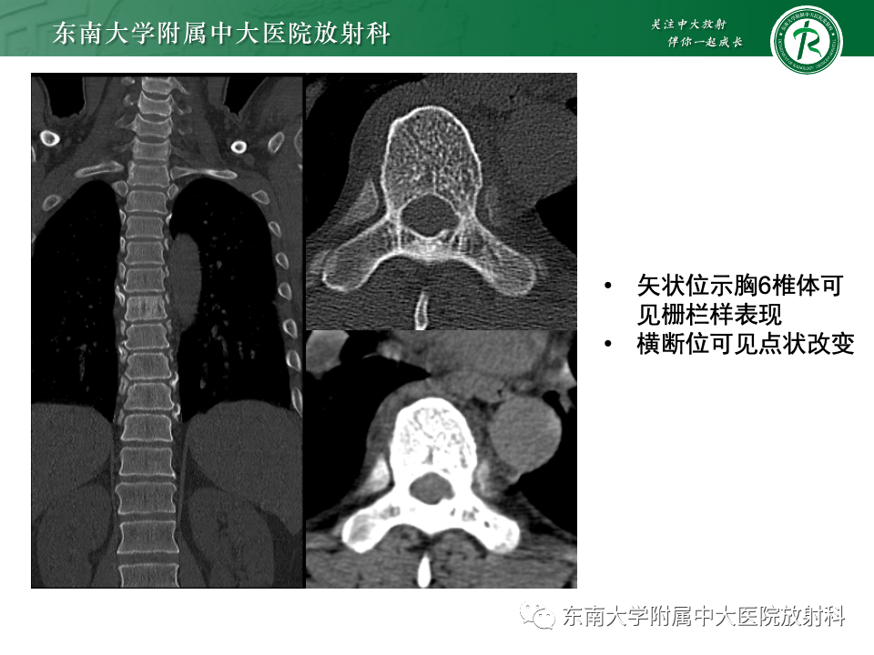 影像PPT - 【PPT】骨孤立性浆细胞瘤-22