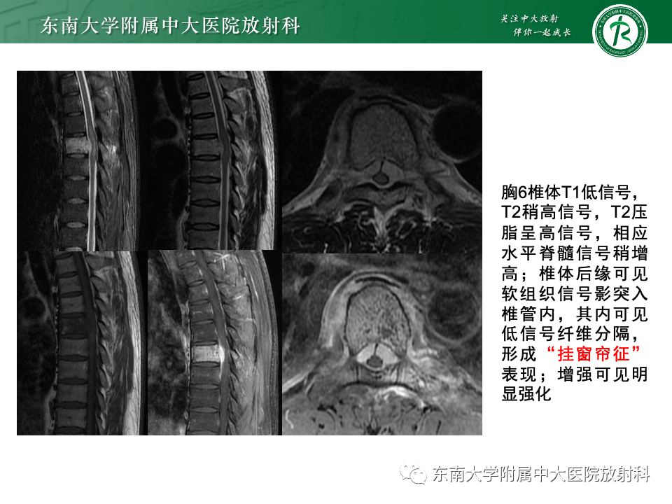 影像PPT - 【PPT】骨孤立性浆细胞瘤-23