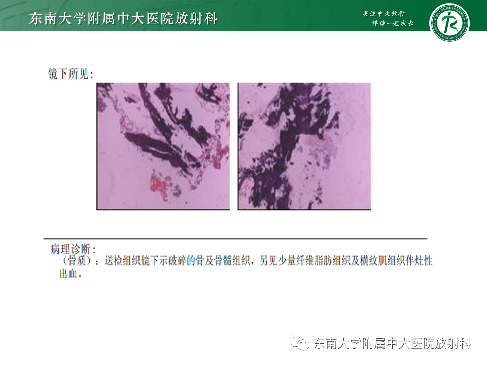 影像PPT - 【PPT】骨孤立性浆细胞瘤-24
