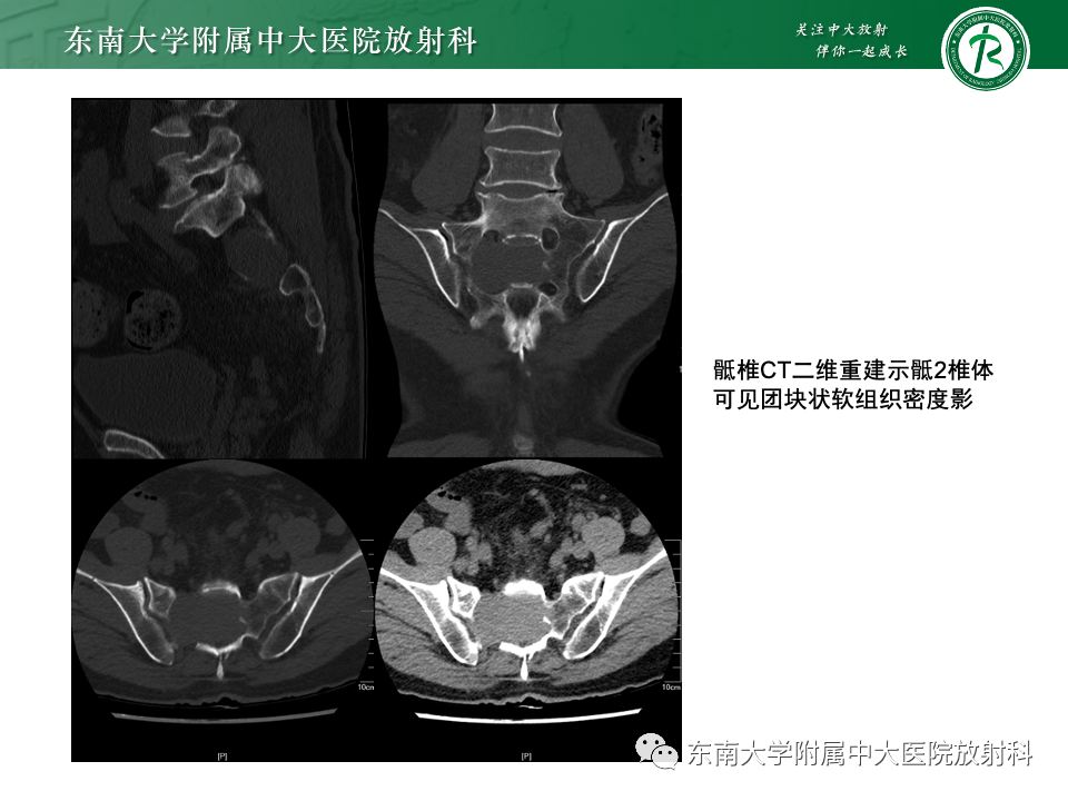 影像PPT - 【PPT】骨孤立性浆细胞瘤-27