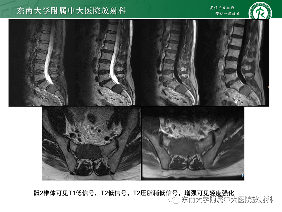 影像PPT - 【PPT】骨孤立性浆细胞瘤-28