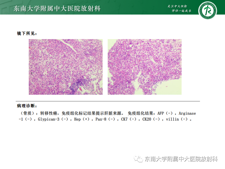 影像PPT - 【PPT】骨孤立性浆细胞瘤-29