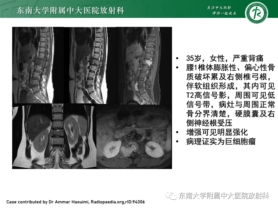 影像PPT - 【PPT】骨孤立性浆细胞瘤-31